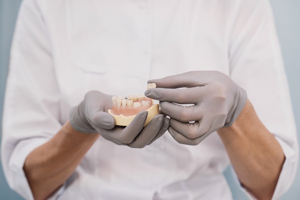 The Average Longevity Of Dental Crowns