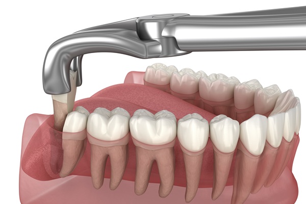 Wisdom Teeth Extractions: When, Why, And What To Expect